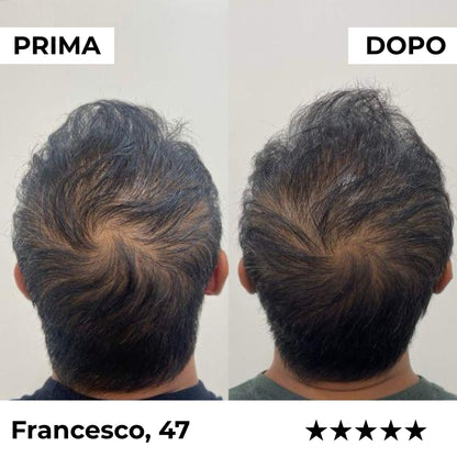 Firmelia – Sistema di microinfusione Firmelià® per la ricrescita dei capelli