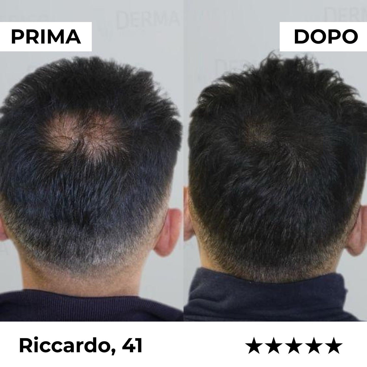 Firmelia – Sistema di microinfusione Firmelià® per la ricrescita dei capelli