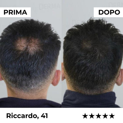 Firmelia – Sistema di microinfusione Firmelià® per la ricrescita dei capelli