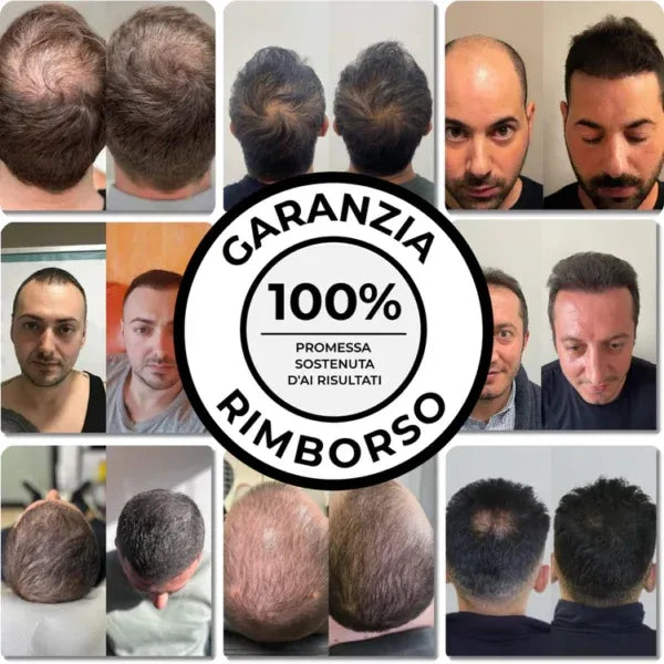 Firmelia – Sistema di microinfusione Firmelià® per la ricrescita dei capelli